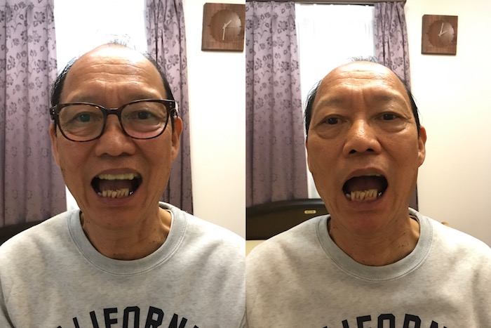 顎関節症